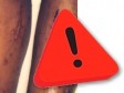 Haiti - ALERT : A very contagious infection detected in several areas of the country